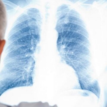 Всемирный день рака лёгких : в Аргентине предупреждают о росте заболеваемости